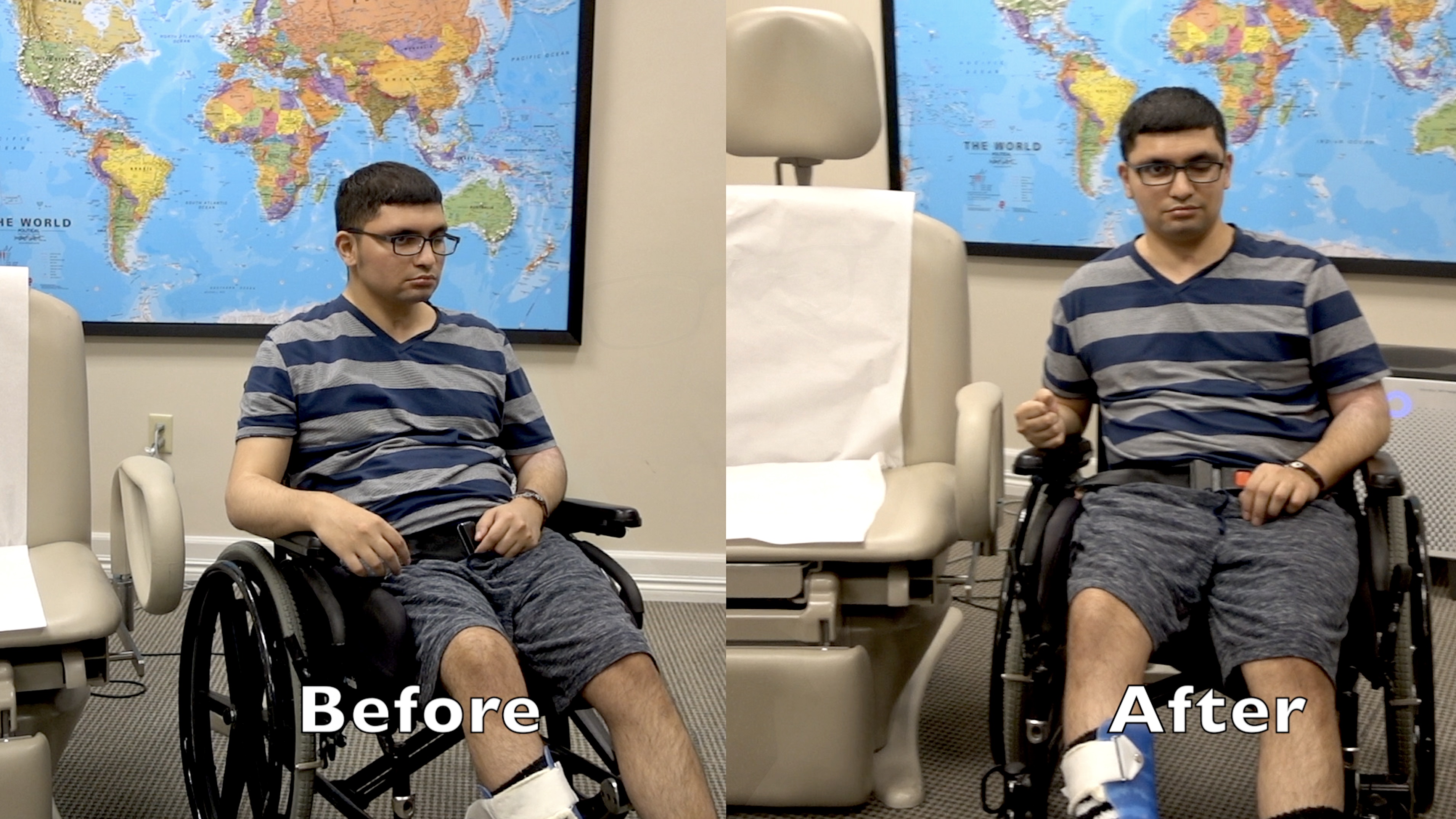 Ataxia rapidly improves after treatment with PSE more than 3 years after stroke